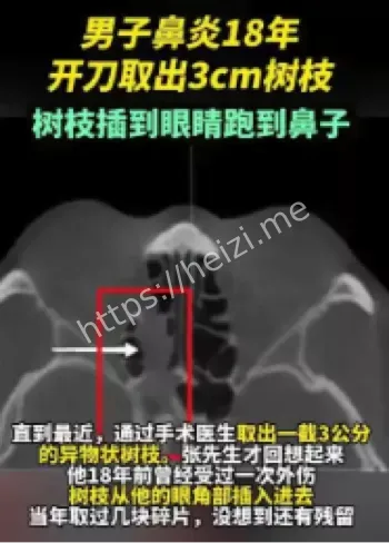 鼻窦异物漏诊案例