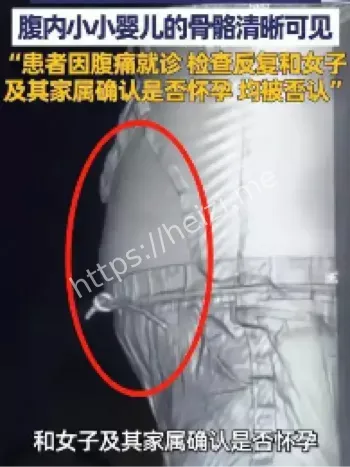 19岁女子腹痛就诊分娩